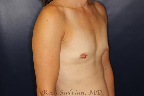 Breast Augmentation Before & After Image