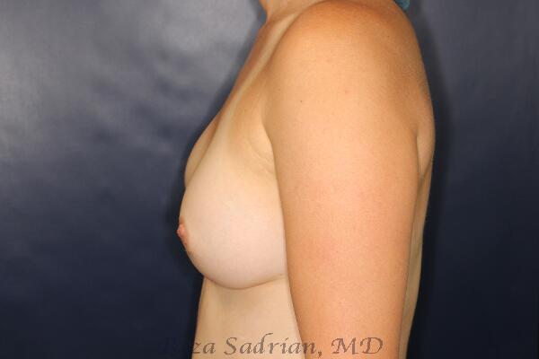 Breast Augmentation Before & After Image