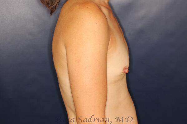 Breast Augmentation Before & After Image