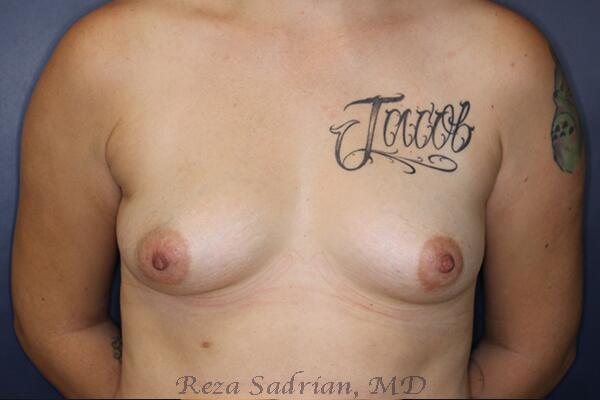 Breast Augmentation Before & After Image