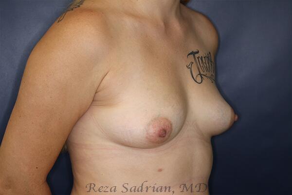 Breast Augmentation Before & After Image