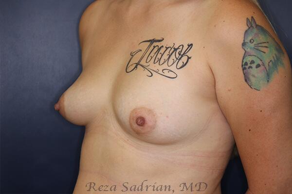 Breast Augmentation Before & After Image