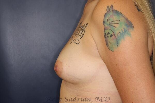 Breast Augmentation Before & After Image