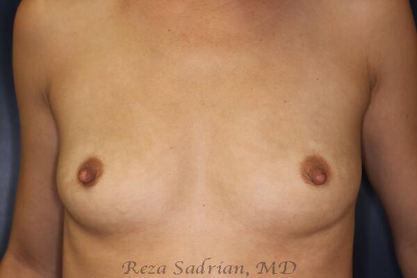 Breast Augmentation Before & After Image