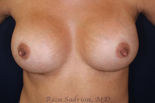 Breast Augmentation Before & After Image