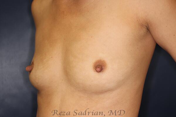 Breast Augmentation Before & After Image