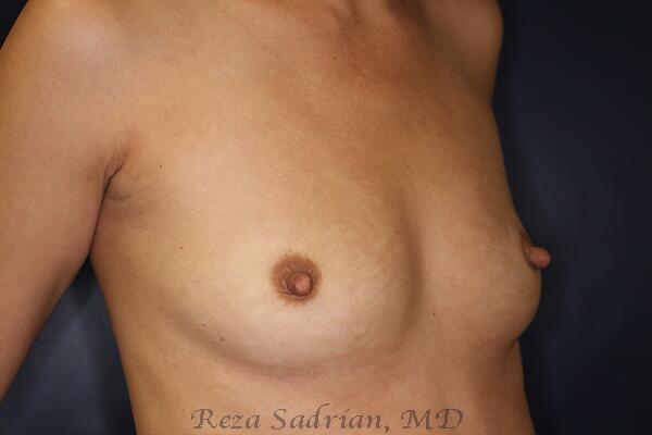 Breast Augmentation Before & After Image