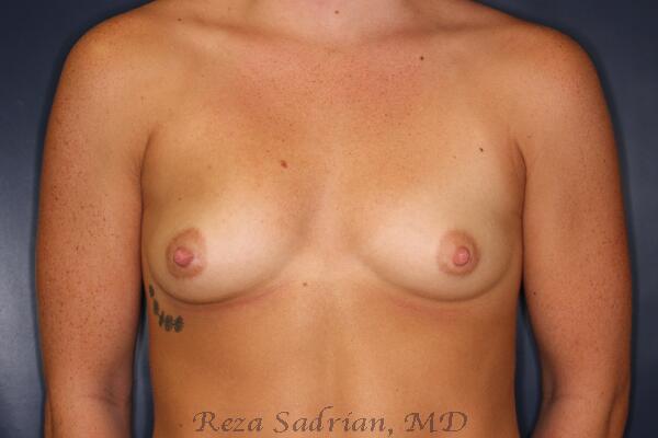 Breast Augmentation Before & After Image