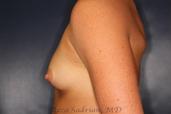 Breast Augmentation Before & After Image