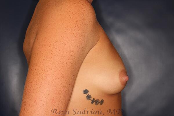 Breast Augmentation Before & After Image