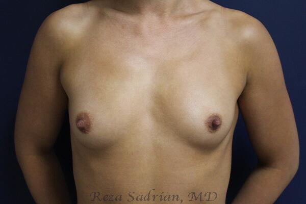 Breast Augmentation Before & After Image