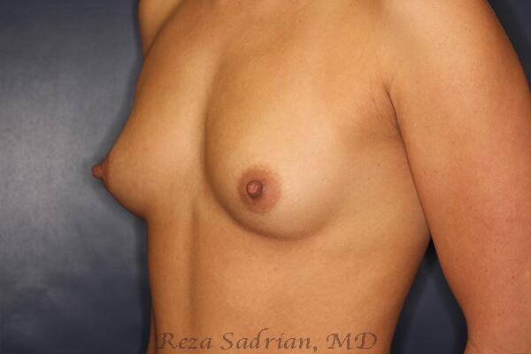 Breast Augmentation Before & After Image