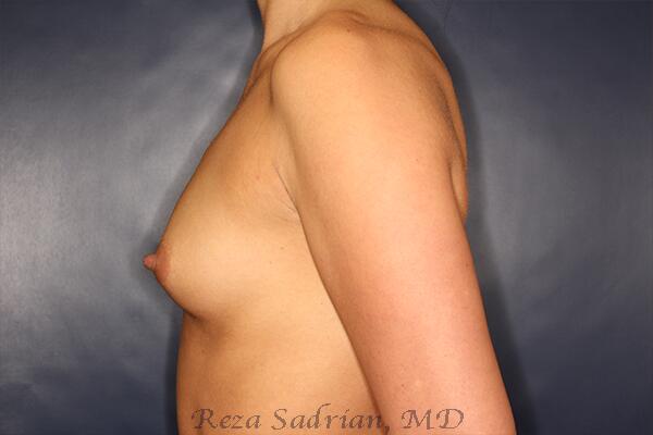 Breast Augmentation Before & After Image