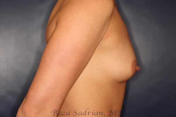 Breast Augmentation Before & After Image