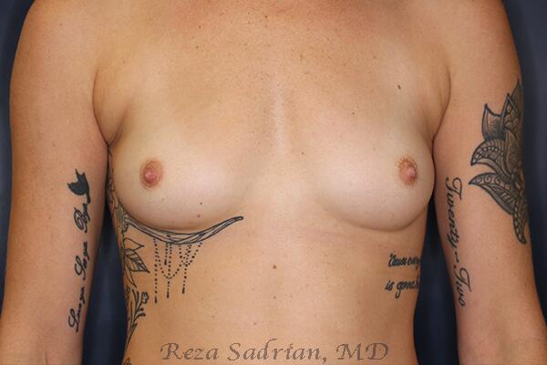 Breast Augmentation Before & After Image