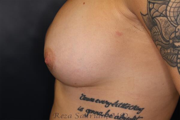 Breast Augmentation Before & After Image