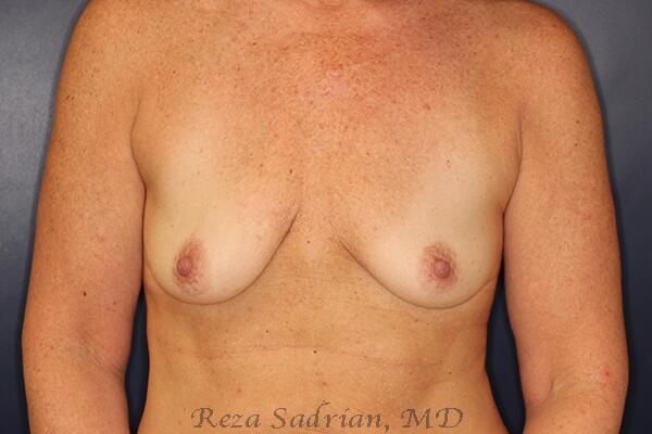 Breast Augmentation Before & After Image