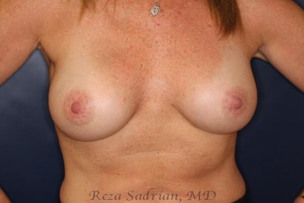 Breast Augmentation Before & After Image