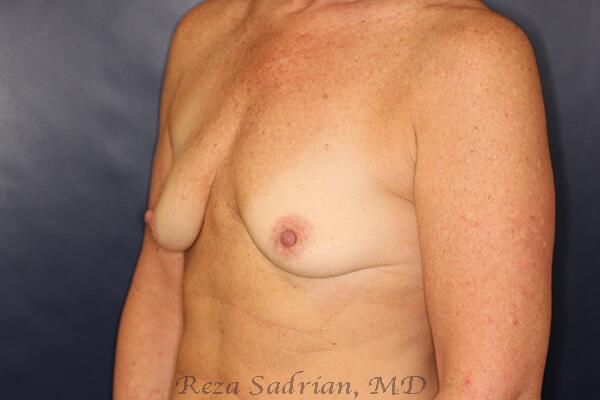 Breast Augmentation Before & After Image