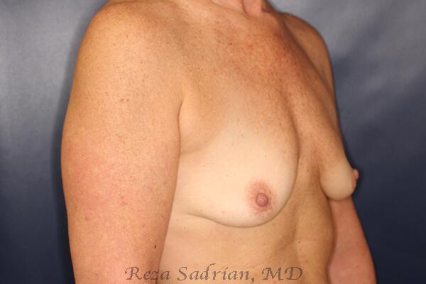 Breast Augmentation Before & After Image