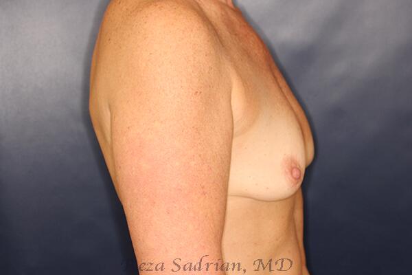 Breast Augmentation Before & After Image