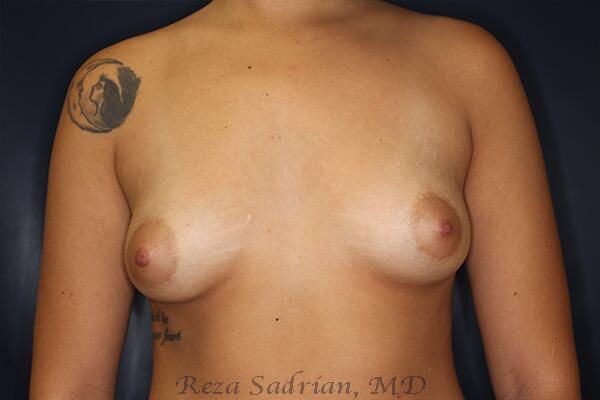 Breast Augmentation Before & After Image