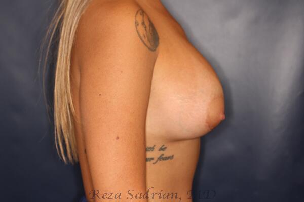 Breast Augmentation Before & After Image