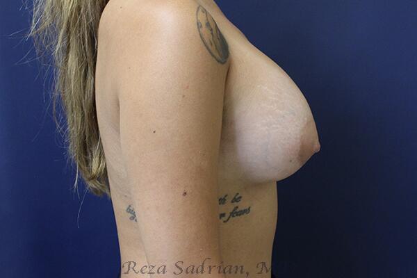 Breast Augmentation Before & After Image