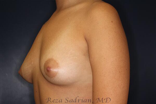 Breast Augmentation Before & After Image