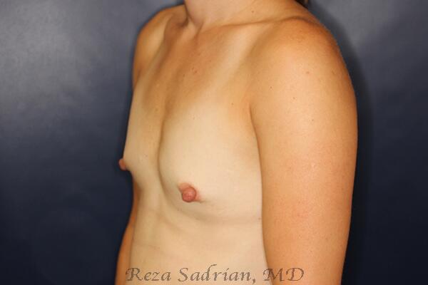 Breast Augmentation Before & After Image