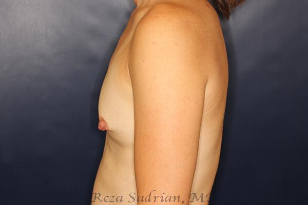 Breast Augmentation Before & After Image