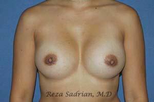 Breast Augmentation Before & After Image