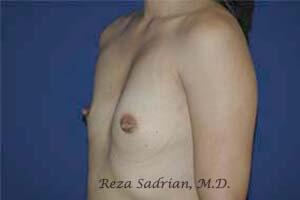 Breast Augmentation Before & After Image