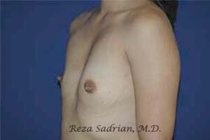 Breast Augmentation Before & After Image