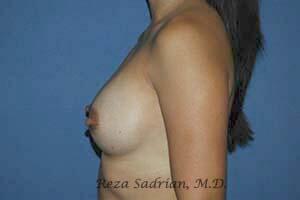 Breast Augmentation Before & After Image