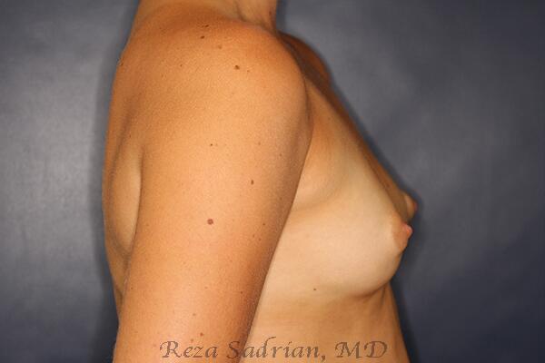 Breast Augmentation Before & After Image