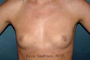 Breast Augmentation Before & After Image