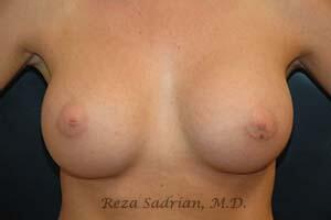 Breast Augmentation Before & After Image