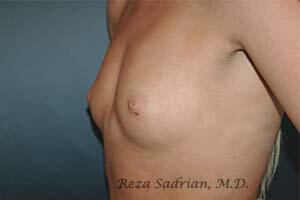 Breast Augmentation Before & After Image