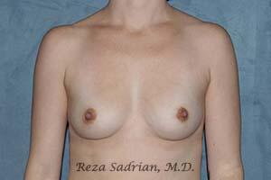 Breast Augmentation Before & After Image