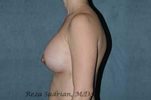 Breast Augmentation Before & After Image