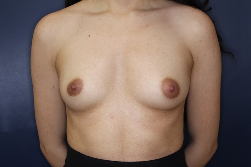 Breast Augmentation Before & After Image