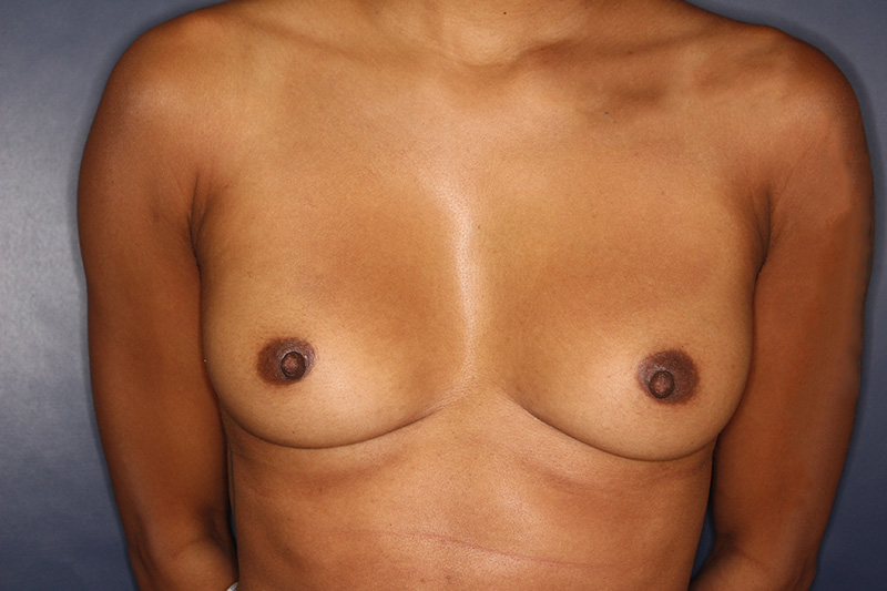 Breast Augmentation Before & After Image