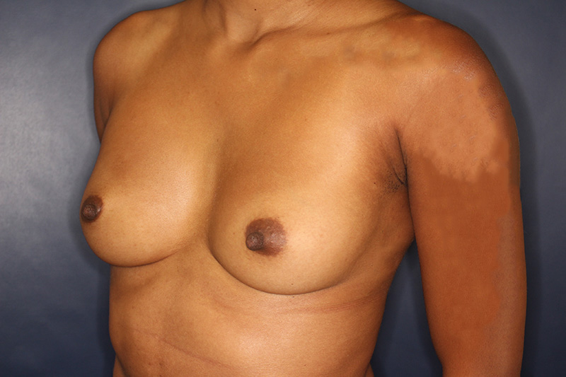 Breast Augmentation Before & After Image