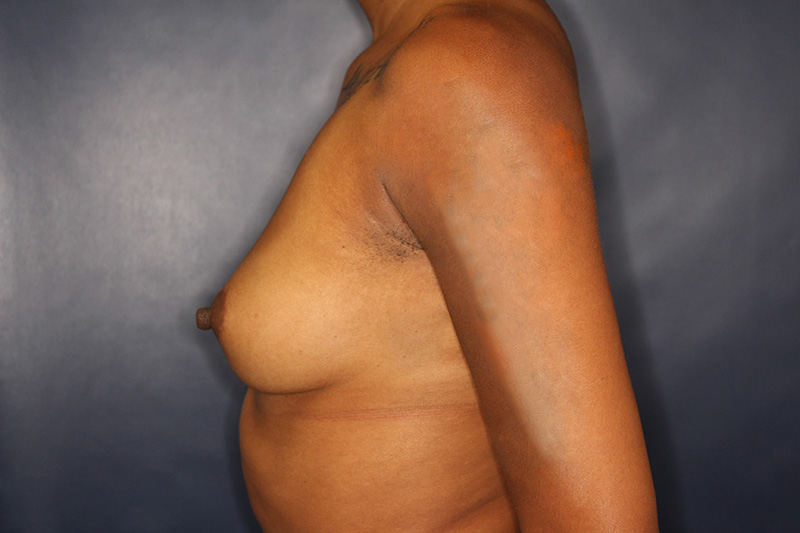 Breast Augmentation Before & After Image