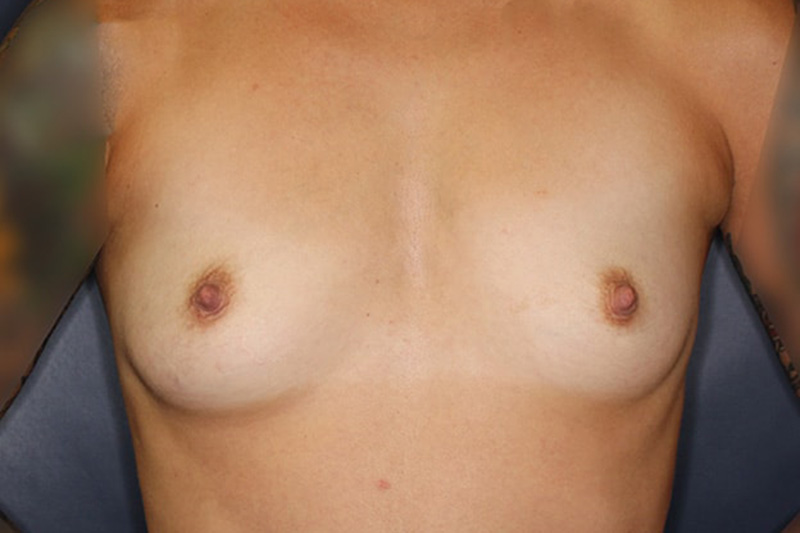 Breast Augmentation Before & After Image