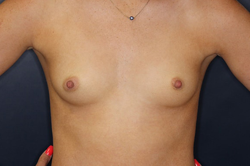 Breast Augmentation Before & After Image