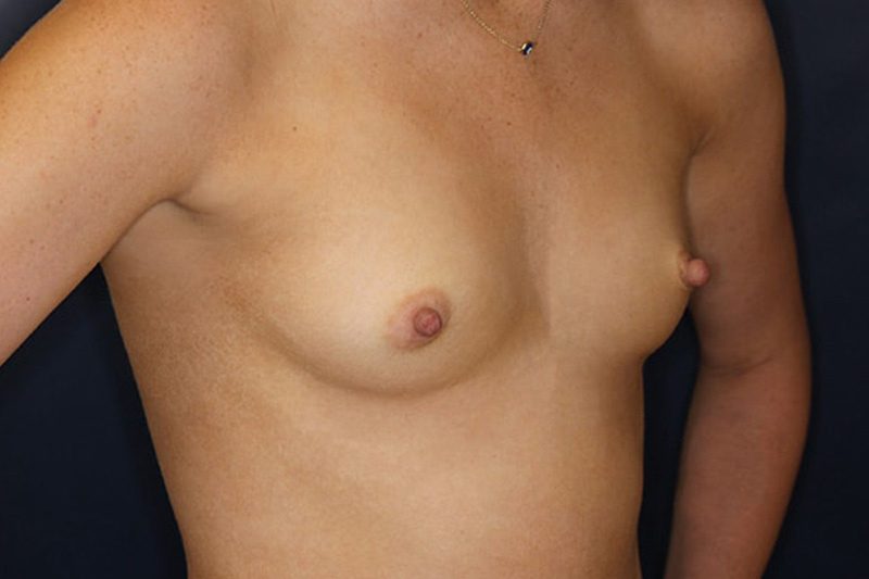 Breast Augmentation Before & After Image