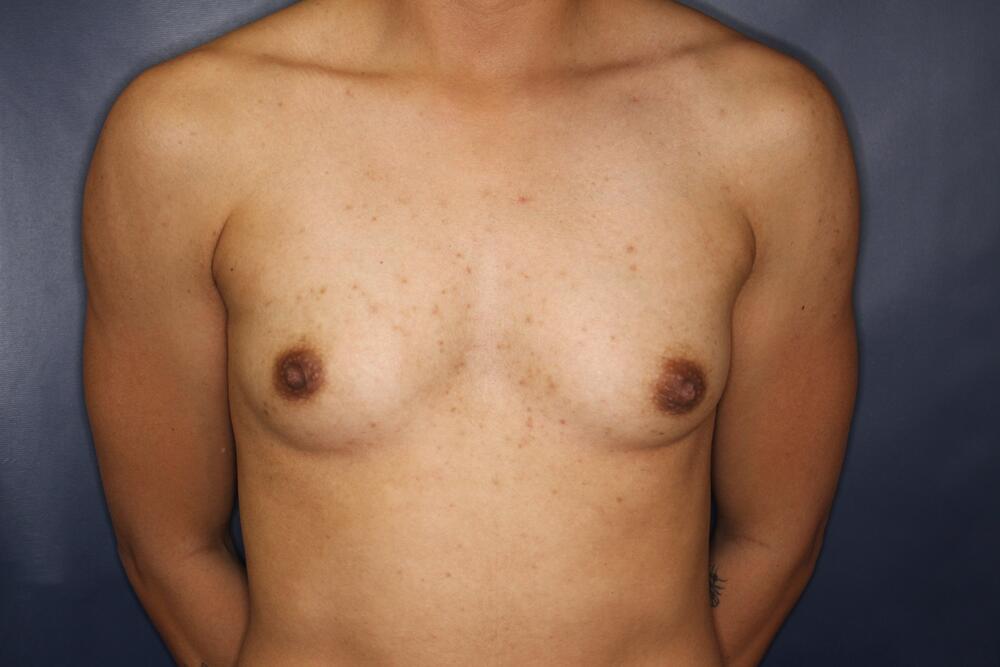 Breast Augmentation Before & After Image