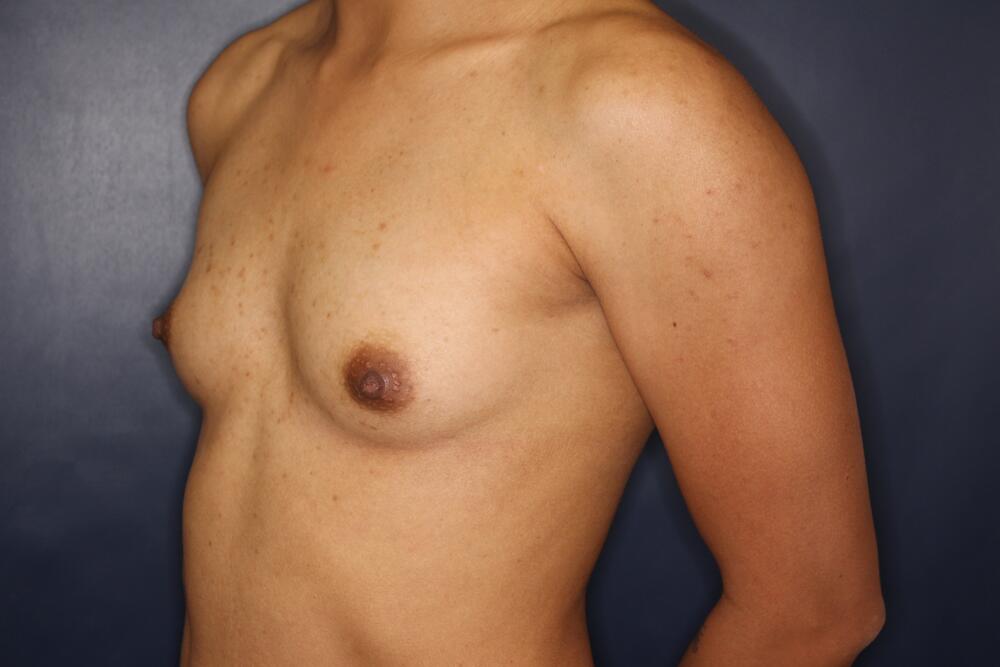 Breast Augmentation Before & After Image